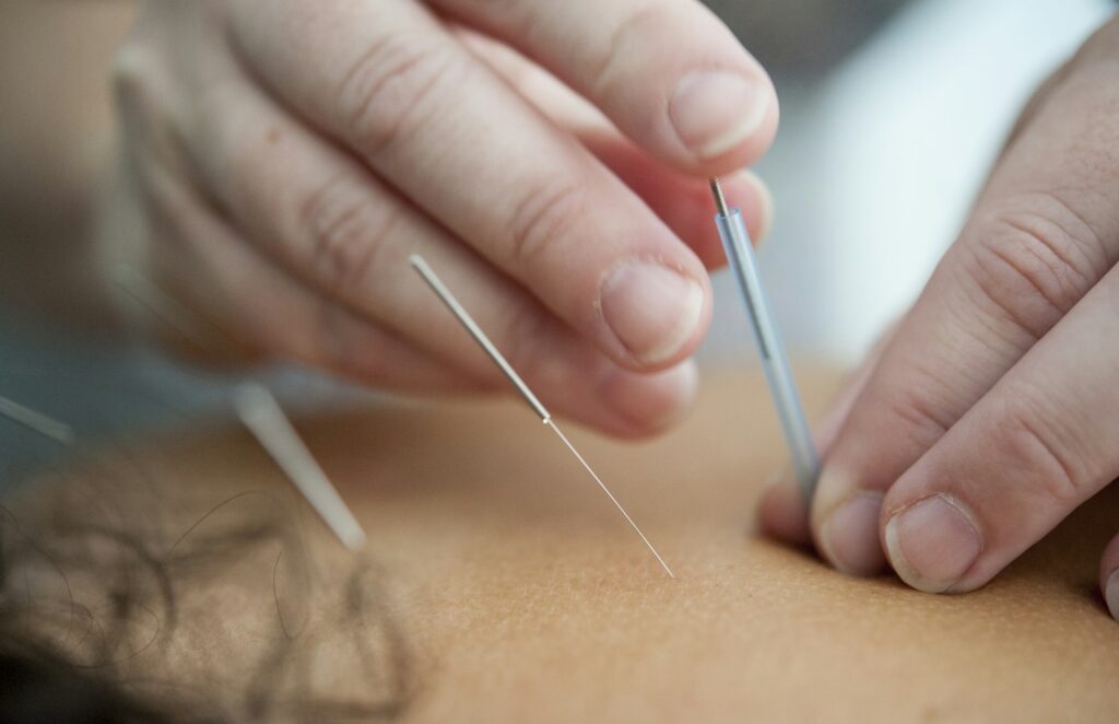 Acupuncture needles inserted into the skin during a treatment